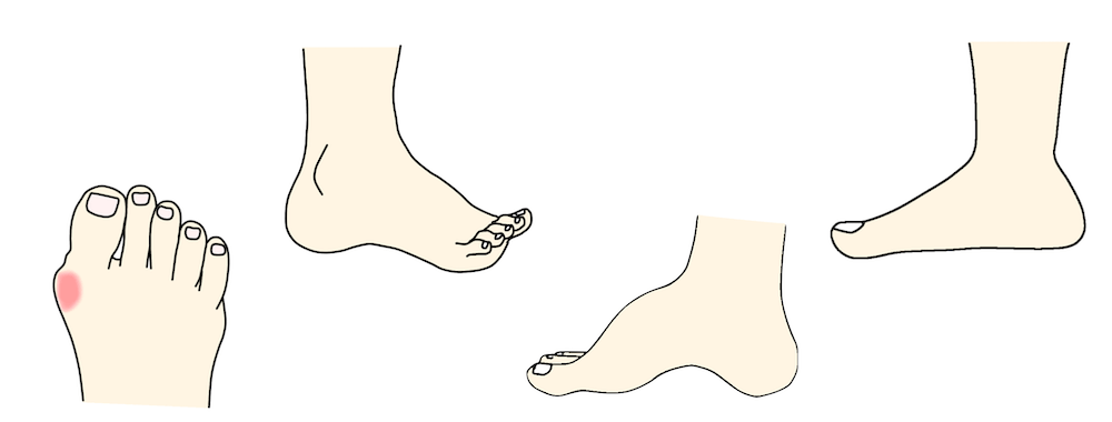 爪と足のアライメント異常の関係　症例画像